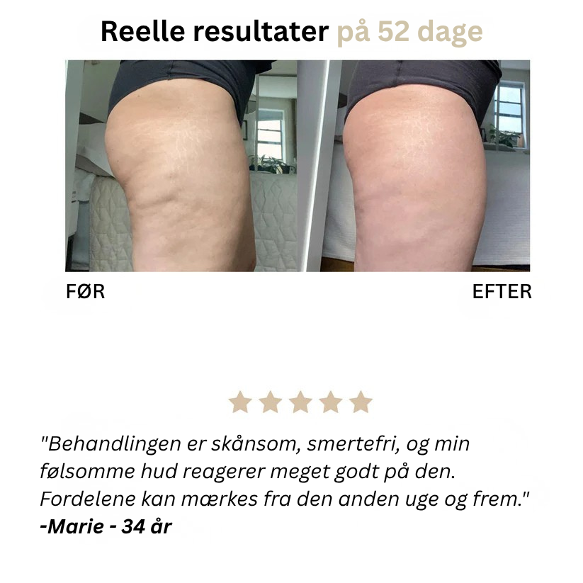 Skinova™ Anti-Cellulite-Massager - Sig farvel til appelsinhud og slap hud