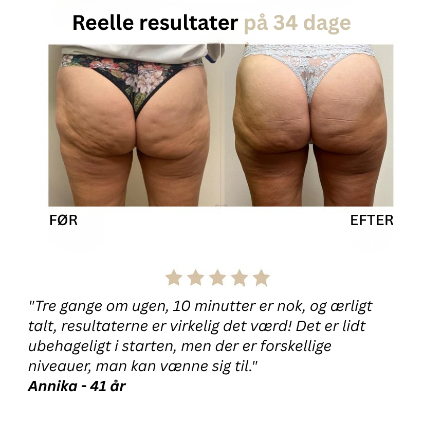 Skinova™ Anti-Cellulite-Massager - Sig farvel til appelsinhud og slap hud