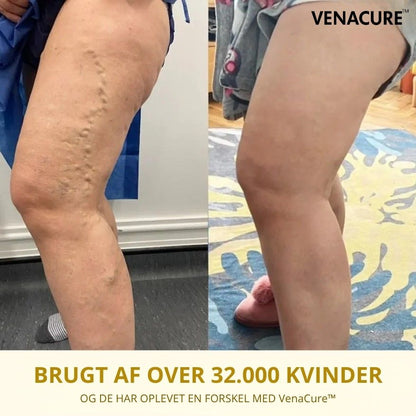 VenaCure™ - Dine åreknuder vil forsvinde efter den første påføring!