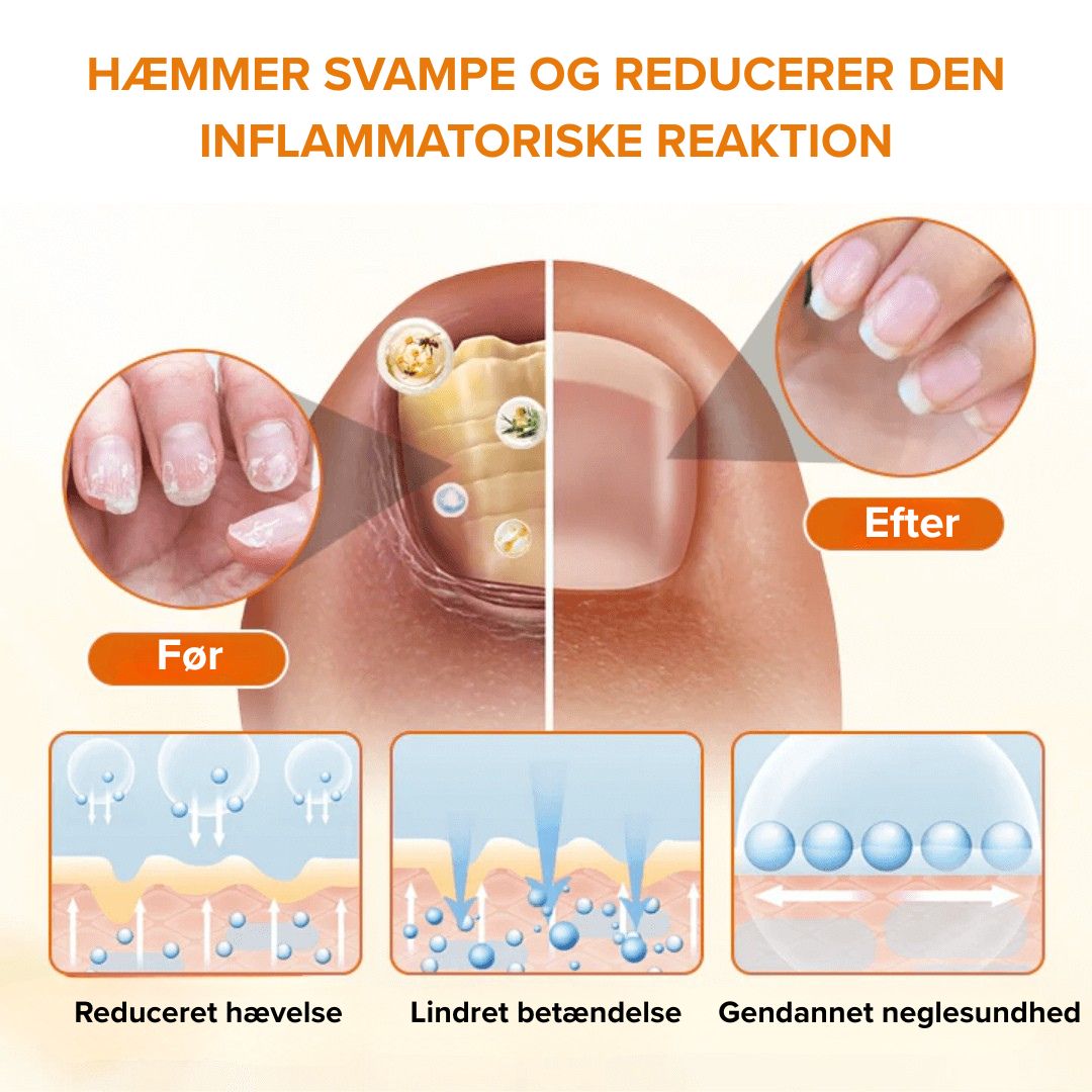 NeglCure™ - 99 % af neglesvampen væk på 7 dage!