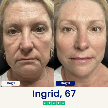 ChinLift™ - Fjern din dobbelthage på 3 uger