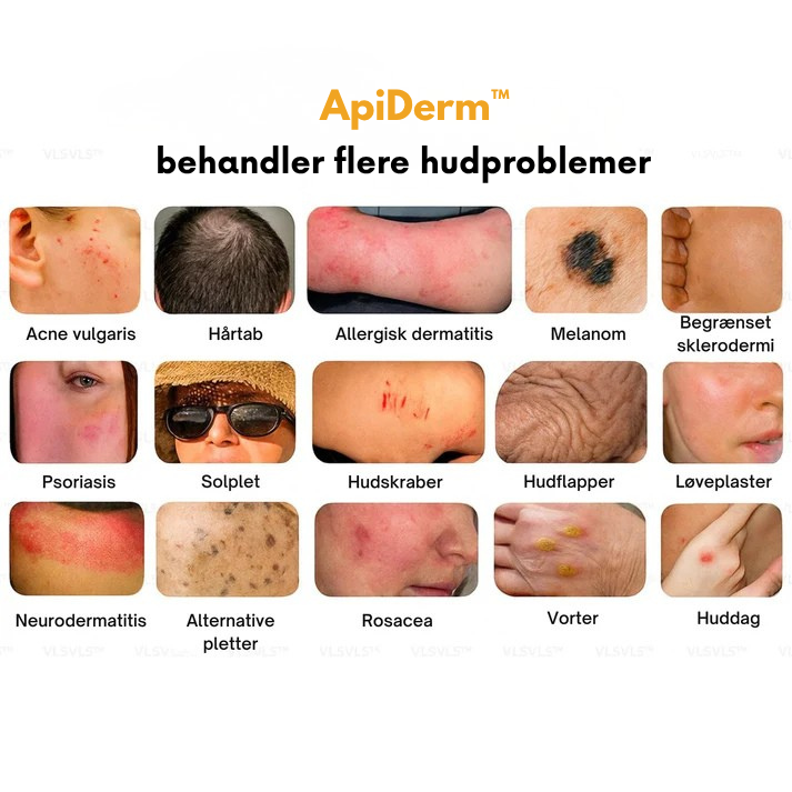 ApiDerm™ - Styrker skrøbelig hud & reducerer blå mærker