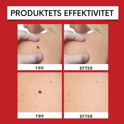 DermaFix™ | Smertefri fjernelse af vorter og modermærker på få dage