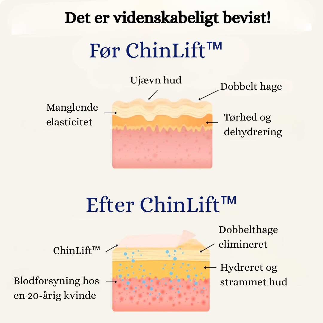 ChinLift™ - Fjern din dobbelthage på 3 uger