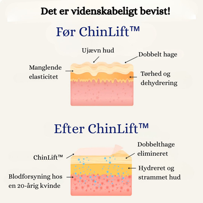 ChinLift™ - Fjern din dobbelthage på 3 uger