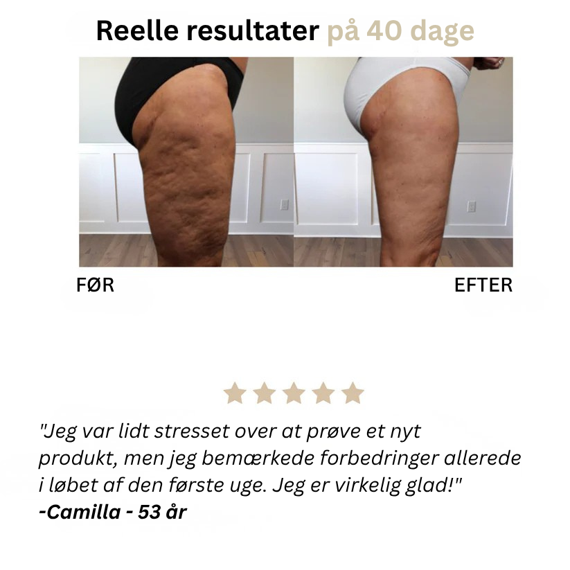 Skinova™ Anti-Cellulite-Massager - Sig farvel til appelsinhud og slap hud