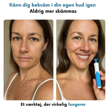 ClearTag™ - Ingen flere hudmærker