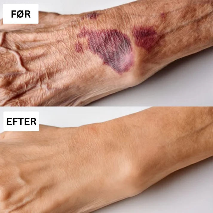 ApiDerm™ - Styrker skrøbelig hud & reducerer blå mærker