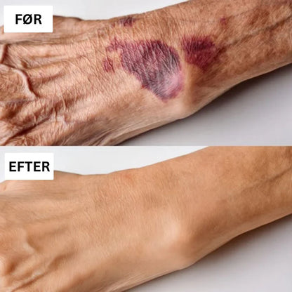 ApiDerm™ - Styrker skrøbelig hud & reducerer blå mærker