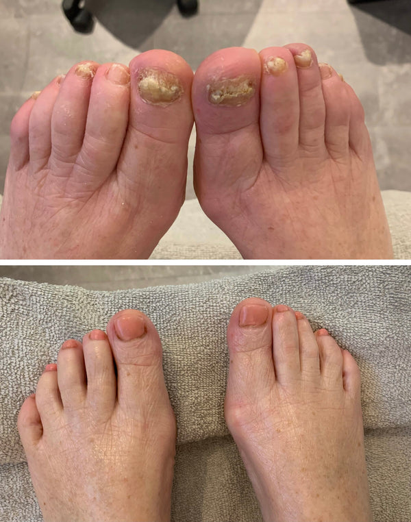 Fra skadet og misfarvet til sundt og stærkt – Se resultaterne med NailCare™