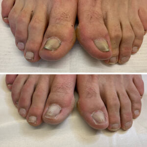 Fra skadet og misfarvet til sundt og stærkt – Se resultaterne med NailCare™