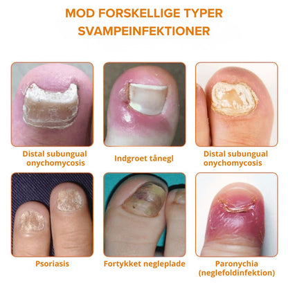 NeglCure™ - 99 % af neglesvampen væk på 7 dage!