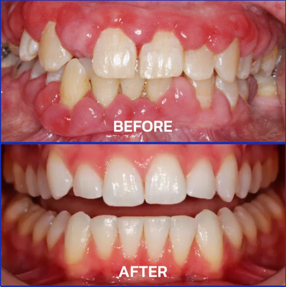 Parodentix™ - Fjerner plak og styrker tandkød naturligt