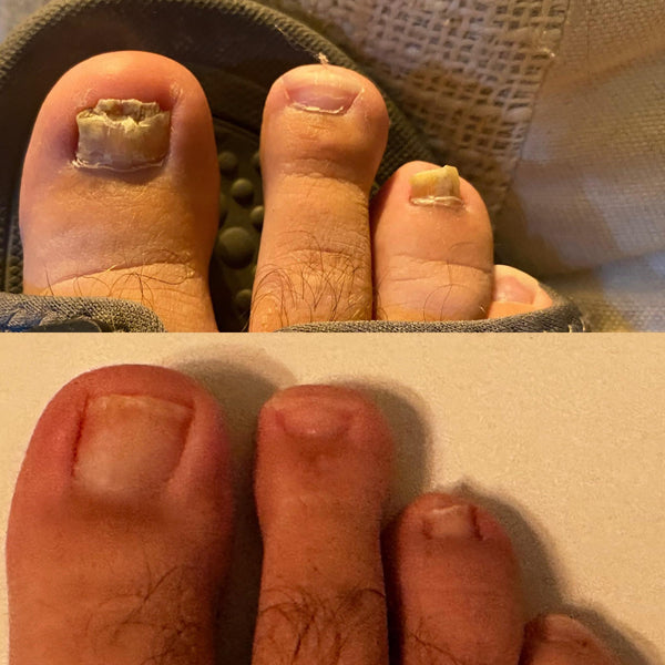 Fra skadet og misfarvet til sundt og stærkt – Se resultaterne med NailCare™
